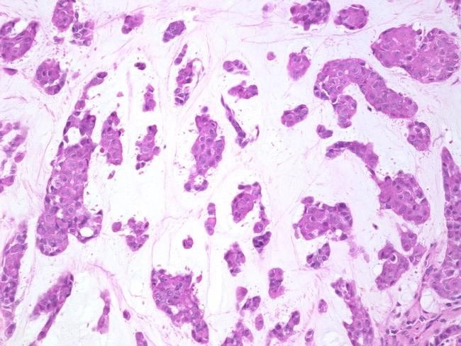 Breast_Carcinoma_Arising in Fibroadenoma3.jpg